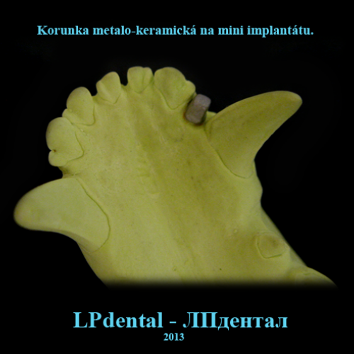 4 Mini implantáty-Мини импланты MDI (Mini Dental Implants)-metalokeramická korunka..png