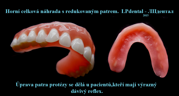 1 Horní celková náhrada s redukovaným patrem z klasické pryskyřice..png
