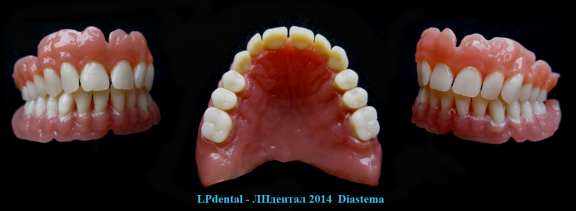 14 Mezera mezi dvěma zuby-Diastema.png