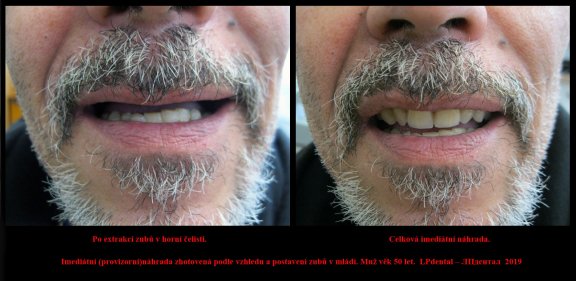 1 Imediátní (provizorní)náhrada zhotovená podle vzhledu a postavení zubů v mládí. Muž věk 50 let..jp