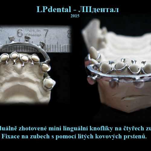 Mini linguální knoflíky na čtyřech zubech.