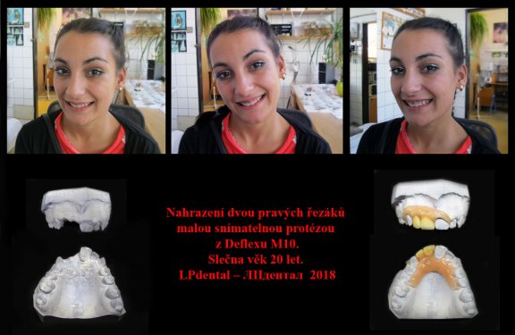 Nahrazení dvou pravých řezáků malou snímatelnou protézou z Deflexu. Slečna věk 20 let. 1