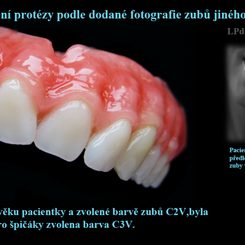 4 Zhotovení protézy podle fotografie zubů jiného člověka..png