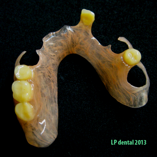 29 LP dental-bezkovová snímatelná náhrada-Deflex.png