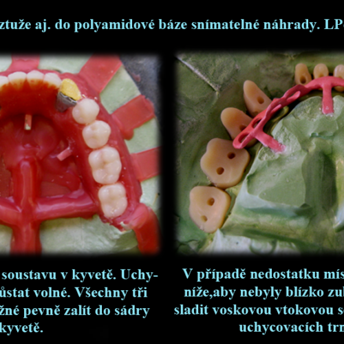 2 Vložení kovové výztuže do polyamidové báze..png