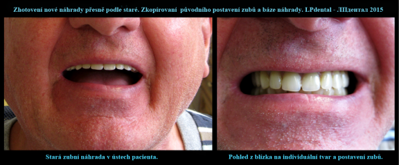 1 Stará zubní náhrada v ústech pacienta..png