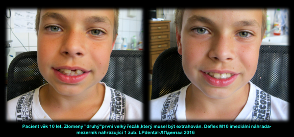 Deflex M10 pacient věk 10 let-imediální mezerník...png