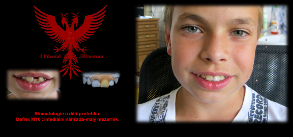 Stomatologie u dětí-imediální mezerník nahrazující 1 zub..png