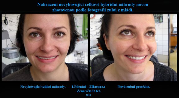 Horní celková hybridní náhrada-fixace systém Locator 0.jpg