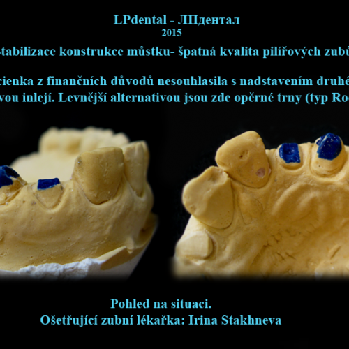 1 Fixní můstky s opěrnými trny-typ Rochett..png