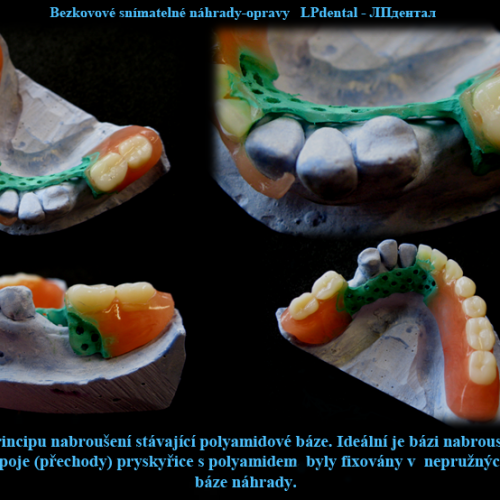 14 Dodání zubu a rozšíření báze pomocí samopolymerující pryskyřice..png