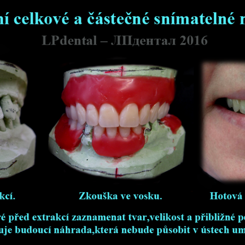 2 Imediální celkové a částečné snímatelné náhrady..png
