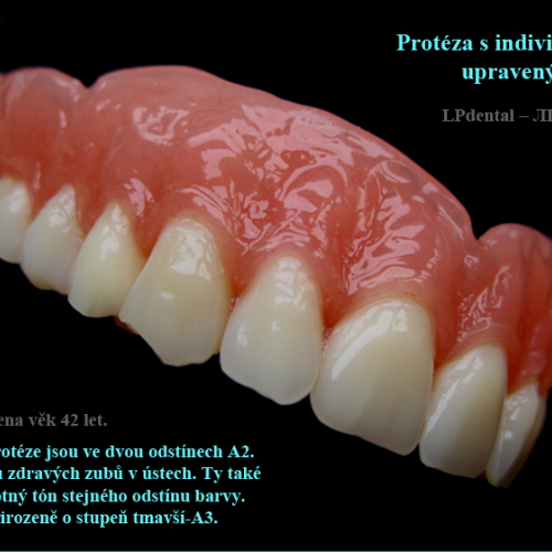 34 Protéza s individuálně tvarově upravenými zuby..png