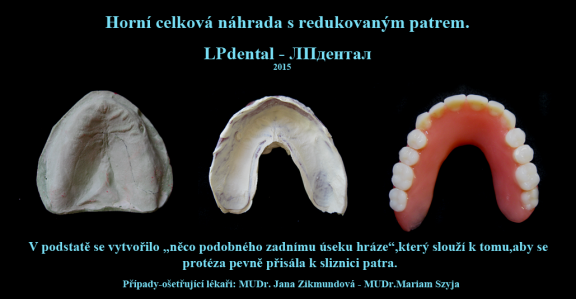 4 Horní celková náhrada s redukovaným patrem z klasické pryskyřice..png