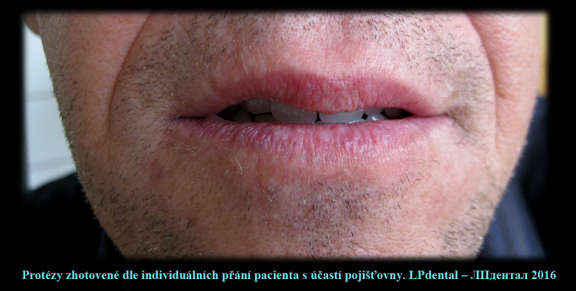 1 Protézy zhotovené dle individuálních přání pacienta s účastí pojišťovny..png