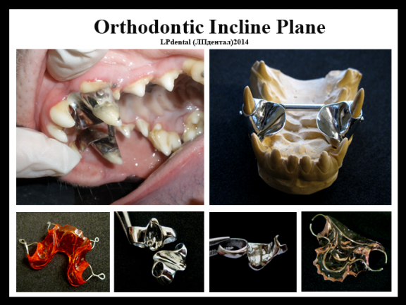 Orthodontic Incline Plane.png