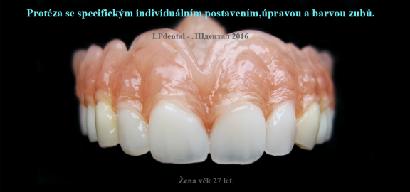 7-1 Protéza se specifickým individuálním postavením,úpravou a barvou zubů..png