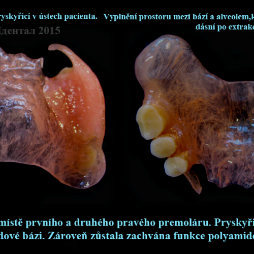 36 Oprava polyamidové náhrady pryskyřicí v ústech pacienta.Vyplnění prostoru mezi bází a alveolem..p