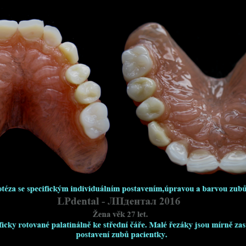 37 Protéza se specifickým individuálním postavením,úpravou a barvou zubů..png