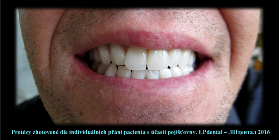 7 Protézy zhotovené dle individuálních přání pacienta s účastí pojišťovny..png