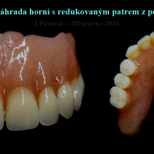 15 Celková snímatelná náhrada horní s redukovaným patrem z polyamidu Deflex M10..png