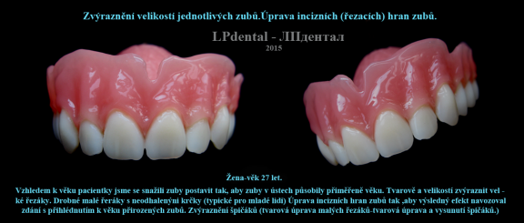 24 Zvýraznění velikostí zubů-úprava incizních hran.png
