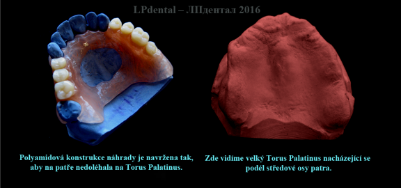 Torus Palatinus (pl.Tori Palatinus)..png