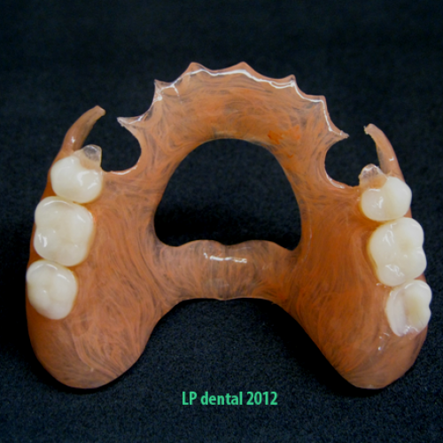 8 LP dental -bezkovová snímatelná náhrada-Deflex.png