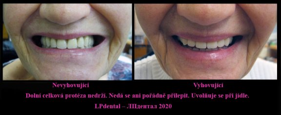 7 Dolní celková protéza nedrží. Nedá se ani pořádně přilepit. Uvolňuje se při jídle..jpg