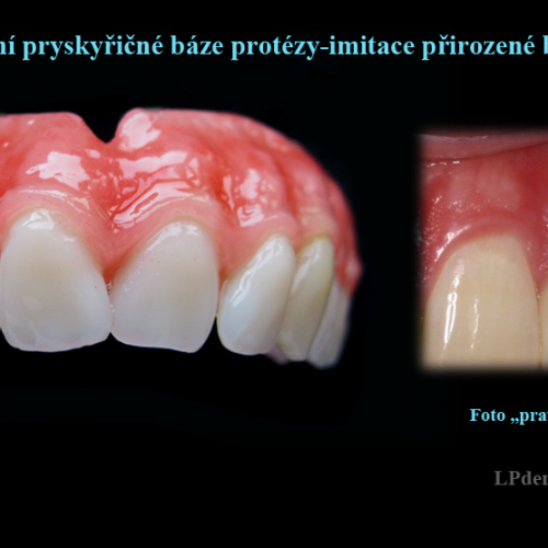 8 Dobarvování pryskyřičné báze protézy-imitace přirozené barvy dásně..png