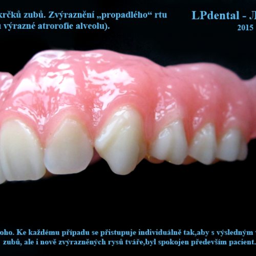 13 Předsunutí krčků zubů.Zvýraznění propadlého rtu..png