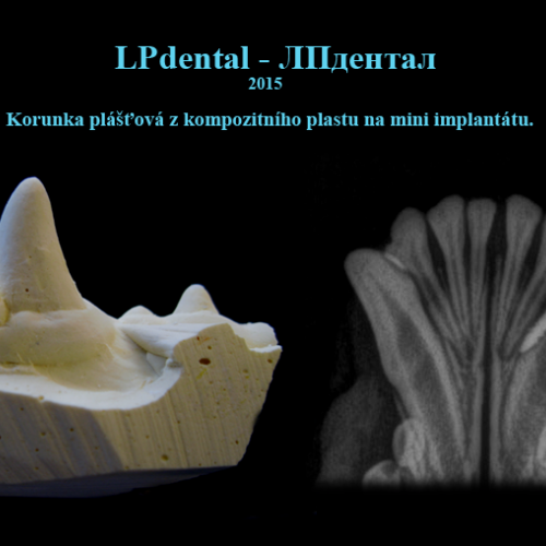 15 Mini implantáty-Мини импланты MDI (Mini Dental Implants)-metalokeramická korunka..png