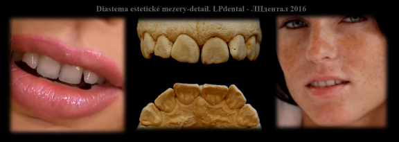 Diastema-estetické mezery mezi zuby.