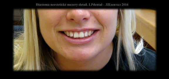 Diastema-neestetické mezery mezi zuby. 