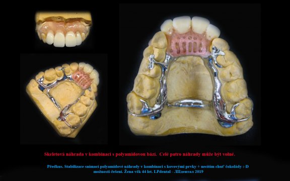 5 Předkus. Stabilizace snímací polyamidové náhrady v kombinaci s kovovými prvky 
