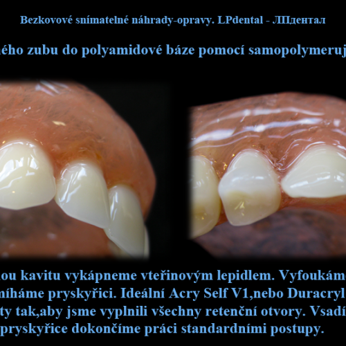 23 Dodání zlomeného zubu do polyamidové báze pomocí samopolymerující pryskyřice..png