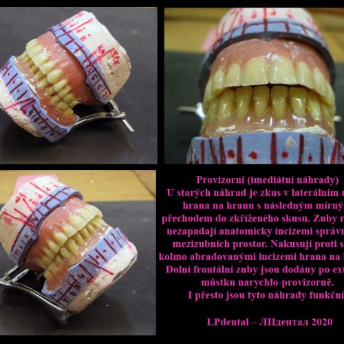 2 Dolní celková protéza nedrží. Nedá se ani pořádně přilepit. Uvolňuje se při jídle..jpg