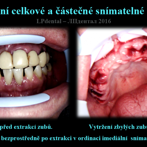 3 Imediální celkové a částečné snímatelné náhrady..png