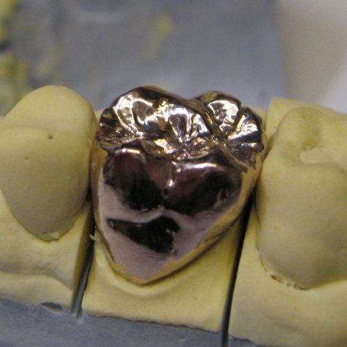 15 LP dental- korunka plášťová celolitá- slitina zlato 18 karátů.jpg