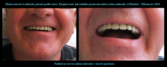 5 Nová zubní náhrada v ústech pacienta..png