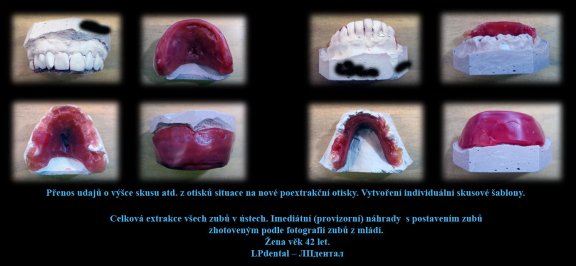 Celková extrakce všech zubů v ústech. Imediátní (provizorní) náhrady  s postavením zubů zhotoveným p