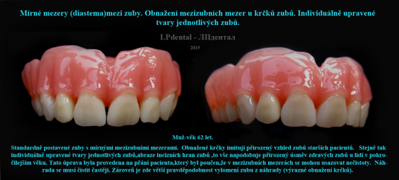 16 Mezizubní mezery-obnažené krčky zubů -individuální úprava tvarů zubů..png
