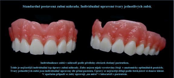 19 Standardně postavená zubní náhrada.Individuálně upravené tvary jednotlivých zubů..png