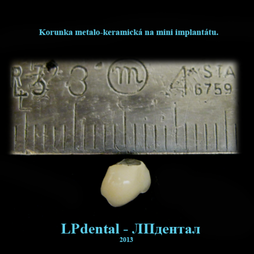 3 Mini implantáty-Мини импланты MDI (Mini Dental Implants)-metalokeramická korunka..png