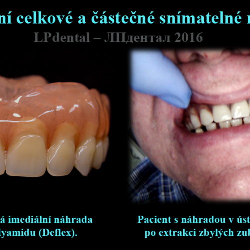 4 Imediální celkové a částečné snímatelné náhrady..png