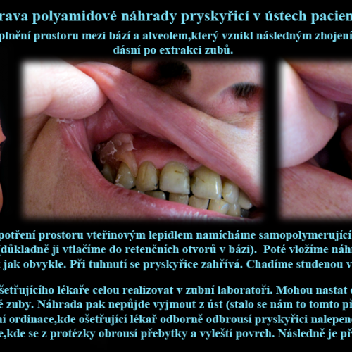 37 Oprava polyamidové náhrady pryskyřicí v ústech pacienta.Vyplnění prostoru mezi bází a alveolem..p