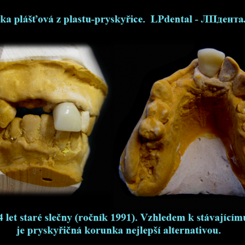 5 Korunka plášťová z plastu-pryskyřice.png.png