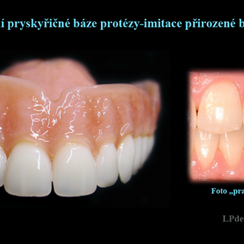 5 Dobarvování pryskyřičné báze protézy-imitace přirozené barvy dásně.png