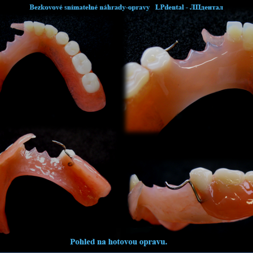 12 Dodání zubu a rozšíření báze pomocí samopolymerující pryskyřice..png