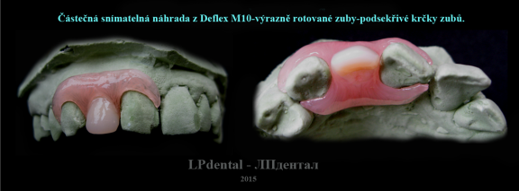 2 Částečná náhrada z Deflex M10-výrazně rotované zuby-podsekřivé krčky zubů..png